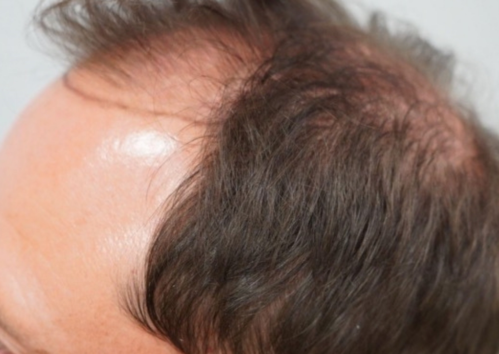 3.5 months topical finasteride with minoxidil hair loss medication