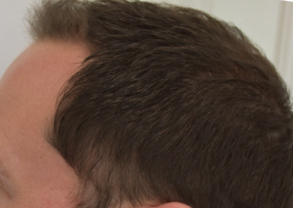 3.5 months topical finasteride with minoxidil hair loss medication