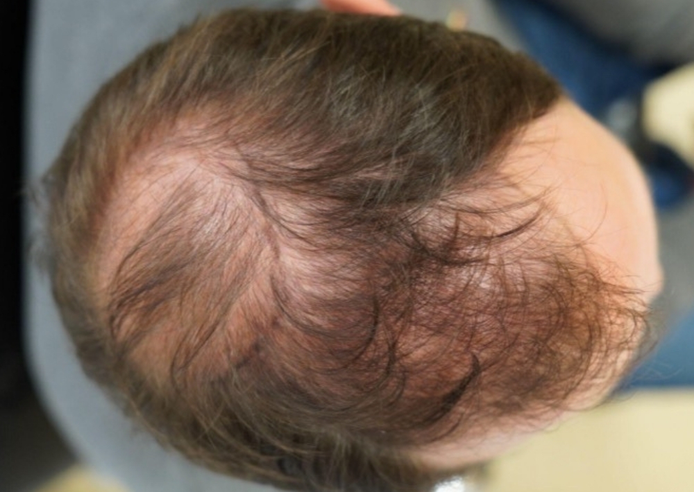 3.5 months topical finasteride with minoxidil hair loss medication