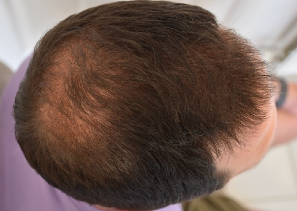 3.5 months topical finasteride with minoxidil hair loss medication
