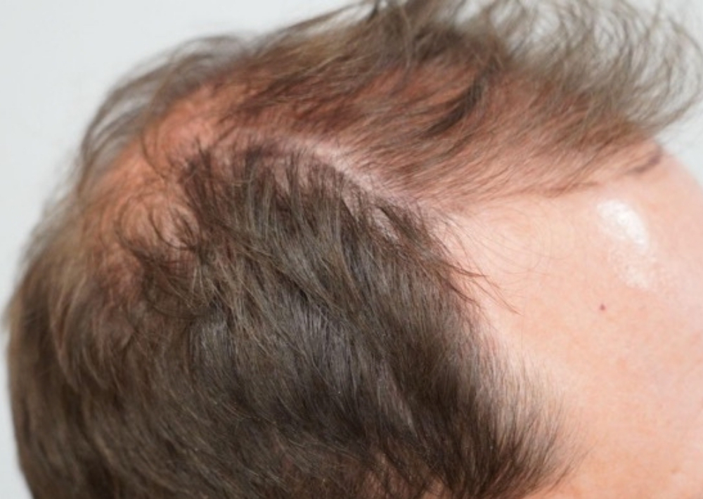 3.5 months topical finasteride with minoxidil hair loss medication
