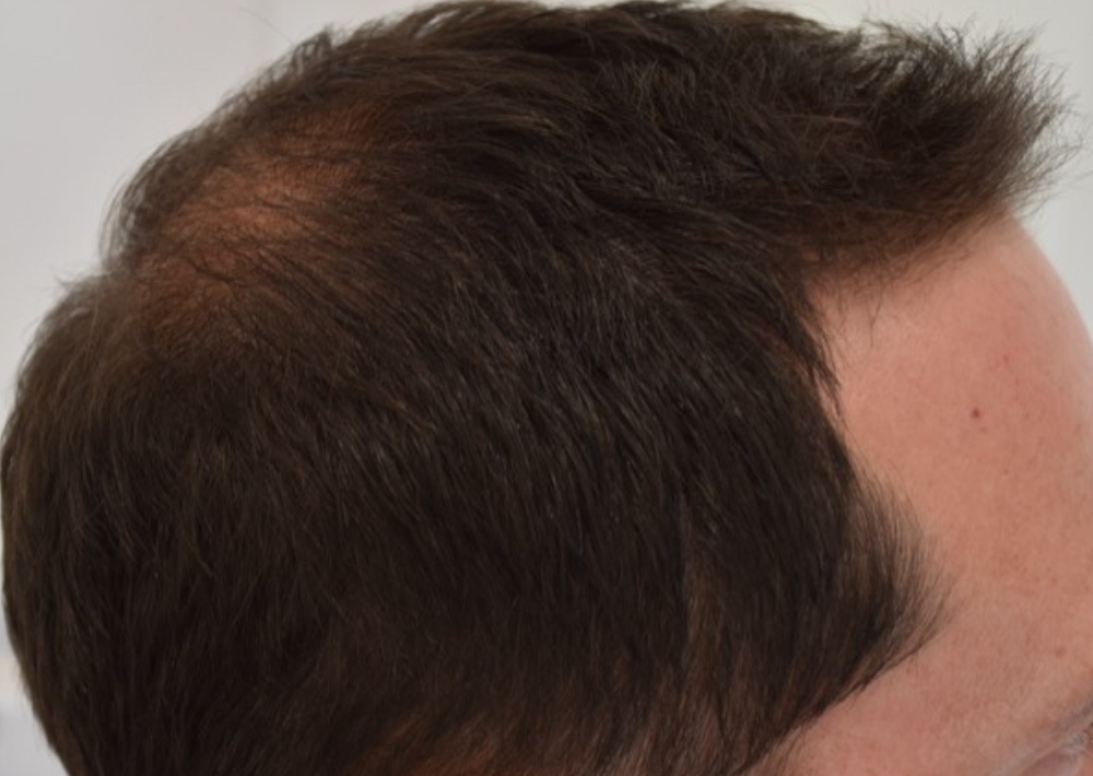 3.5 months topical finasteride with minoxidil hair loss medication