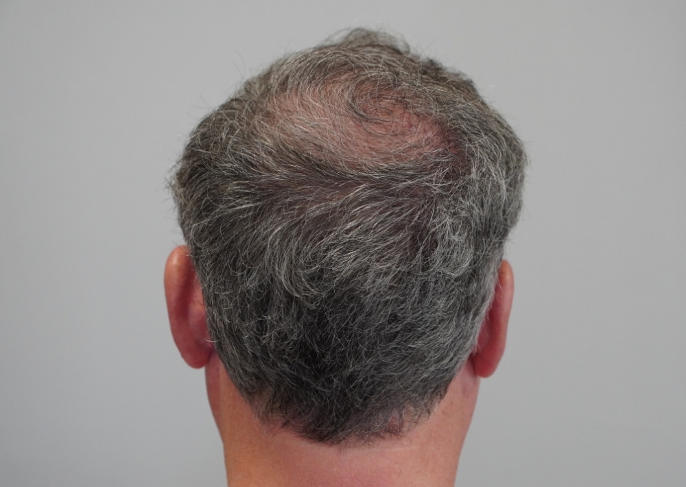 3849 grafts by FUE