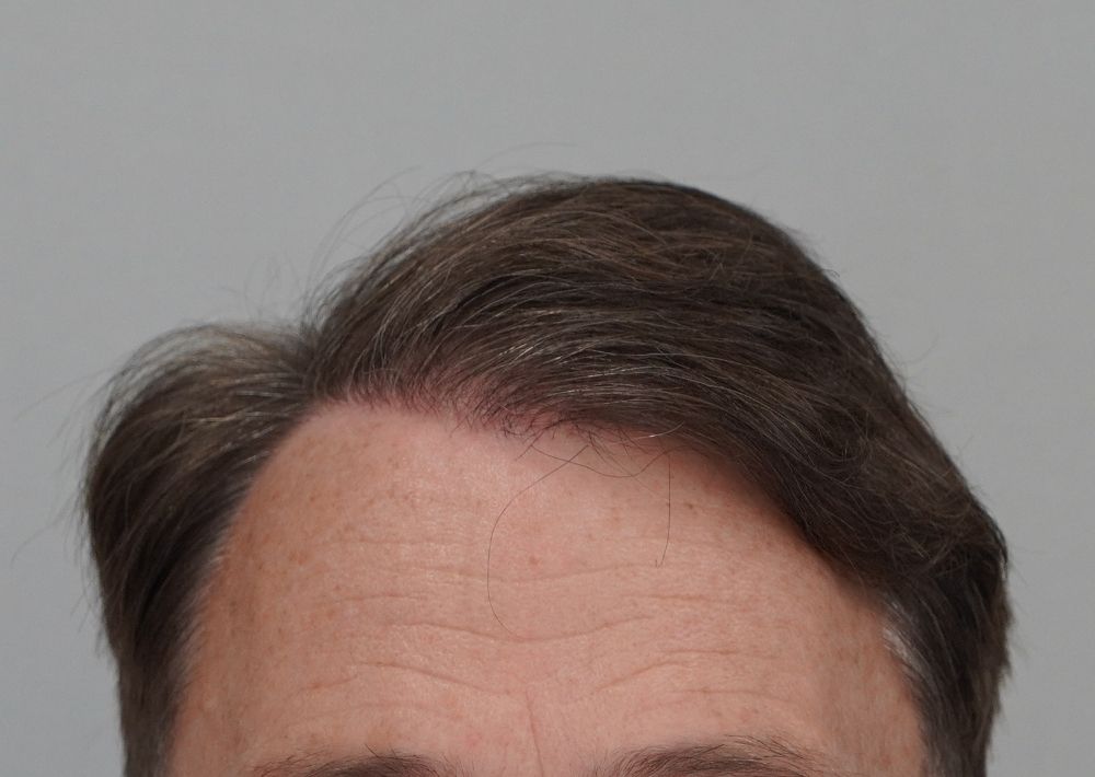50 punches out and 1246 grafts by FUE