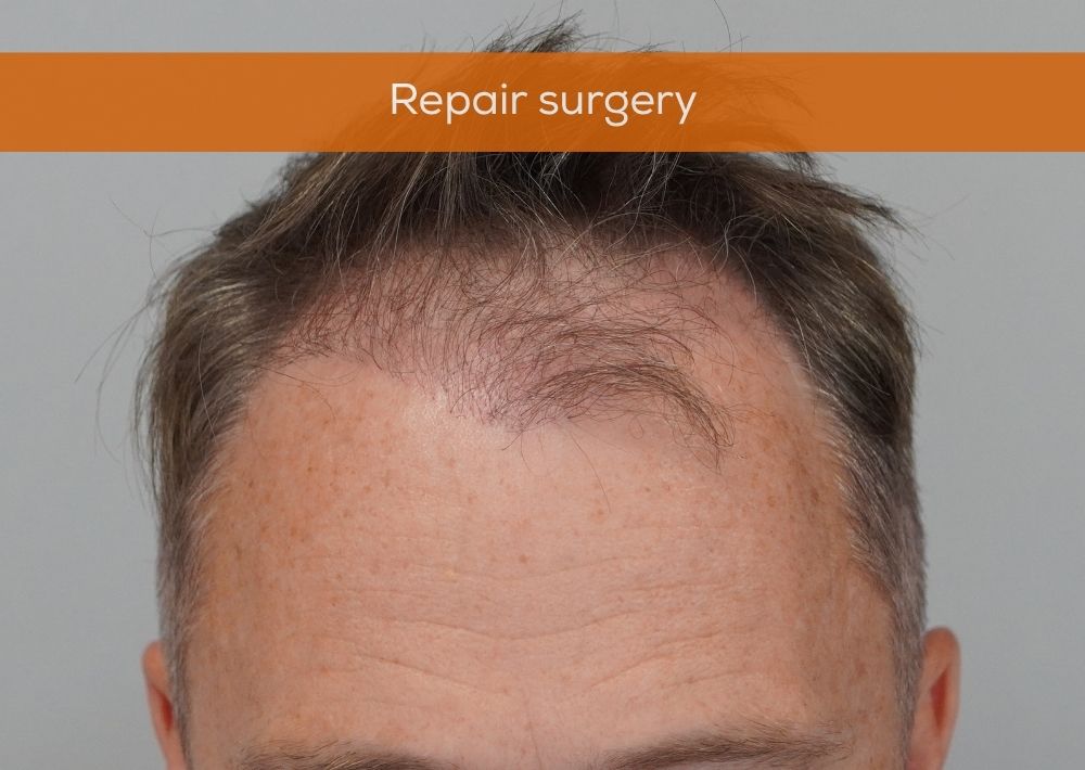 50 punches out and 1246 grafts by FUE