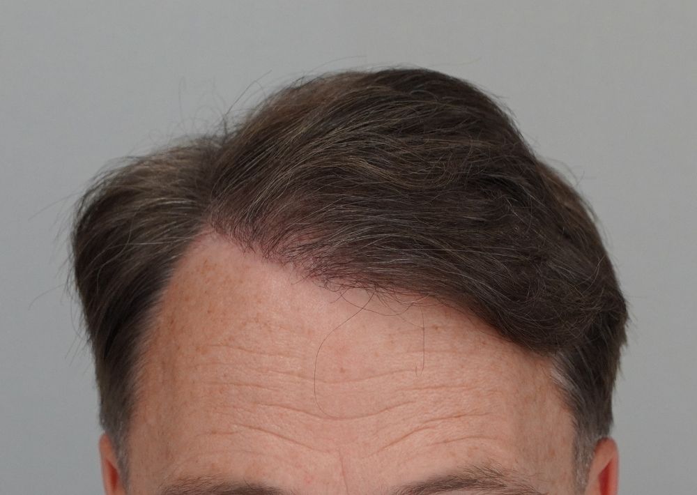 50 punches out and 1246 grafts by FUE