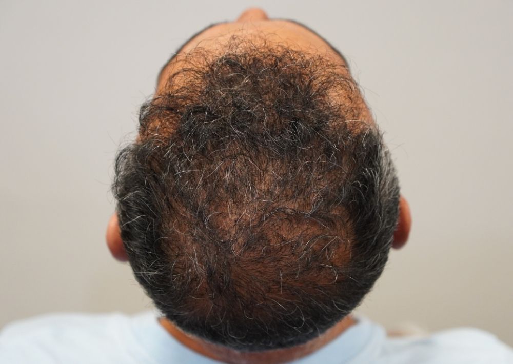 5803 grafts by FUT