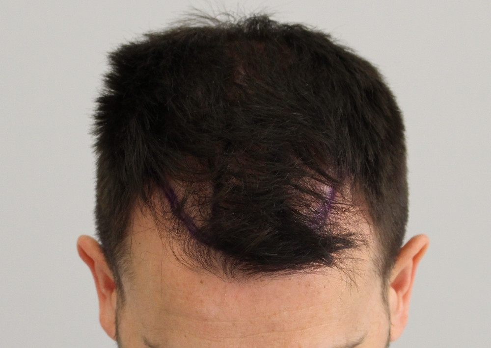 1858 grafts by FUE