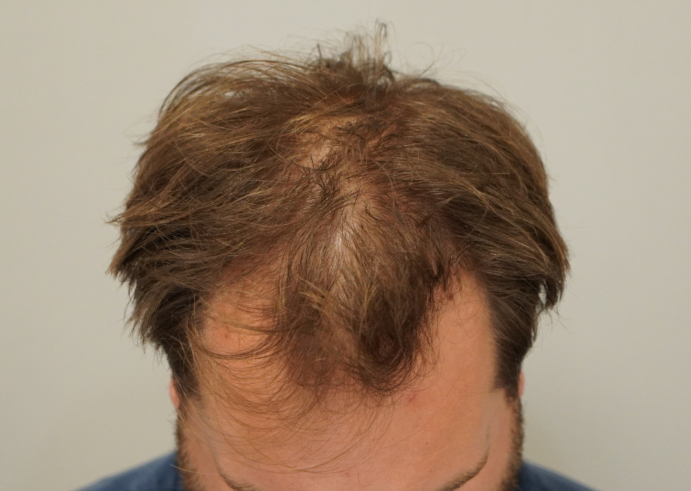 1879 grafts by FUE