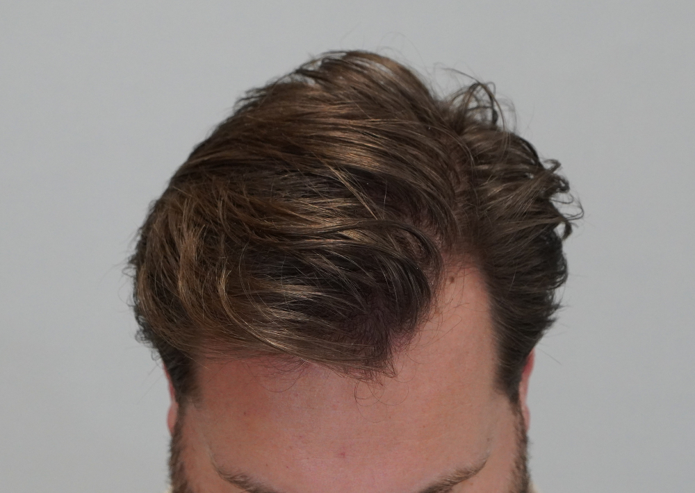 1879 grafts by FUE