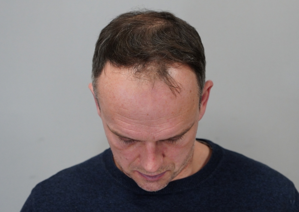 1841 grafts by FUE