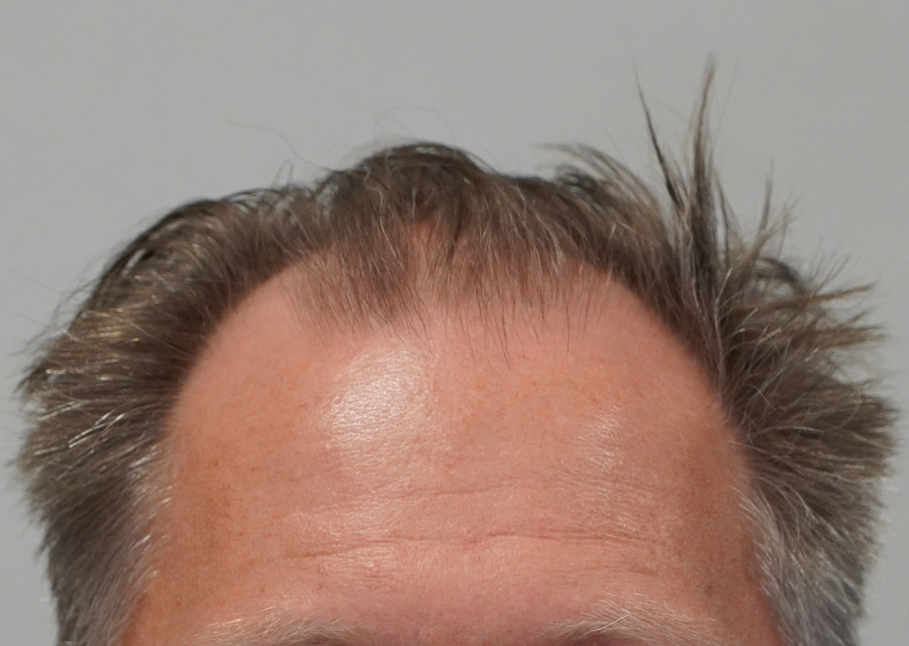 1987 grafts by FUE