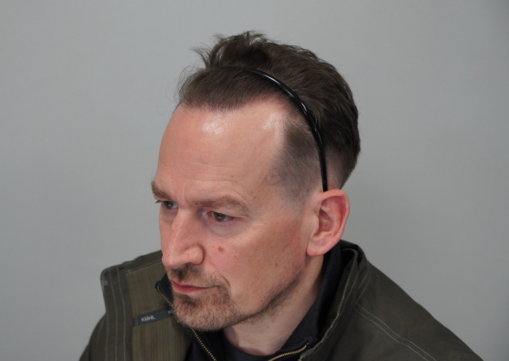 1901 grafts by FUE