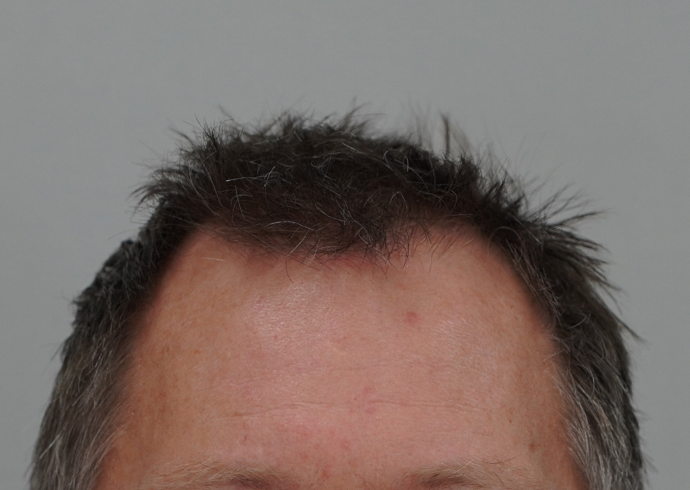 1987 grafts by FUE