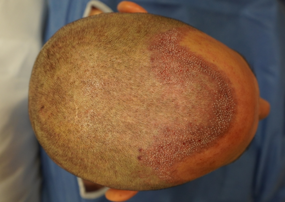 1901 grafts by FUE