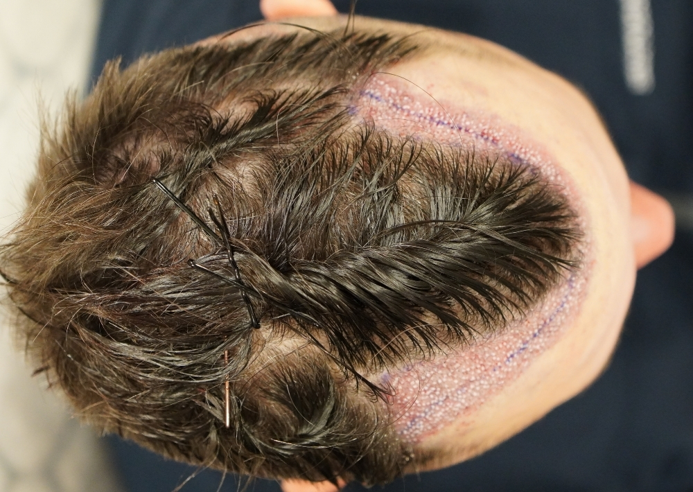 34 punch outs and 904 grafts by FUE