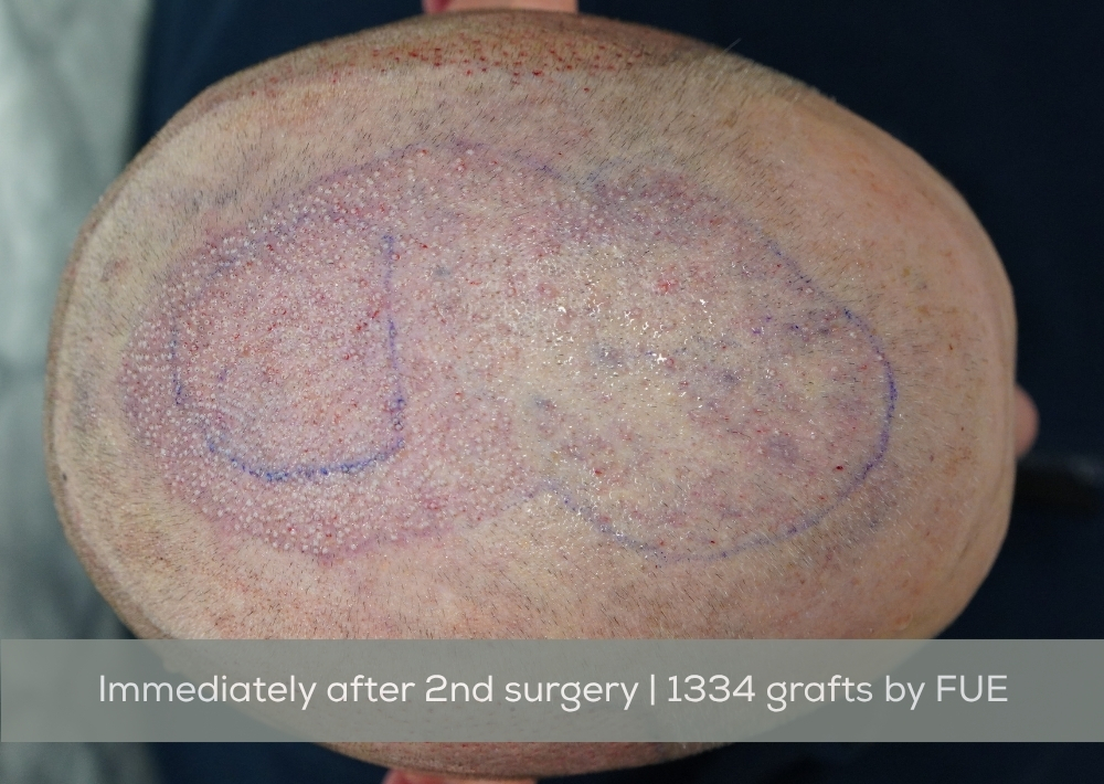 3354 grafts by FUE