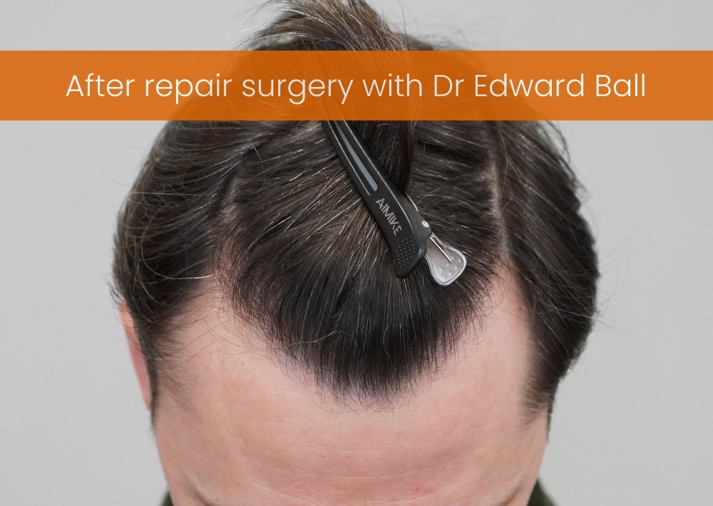 34 punch outs and 904 grafts by FUE