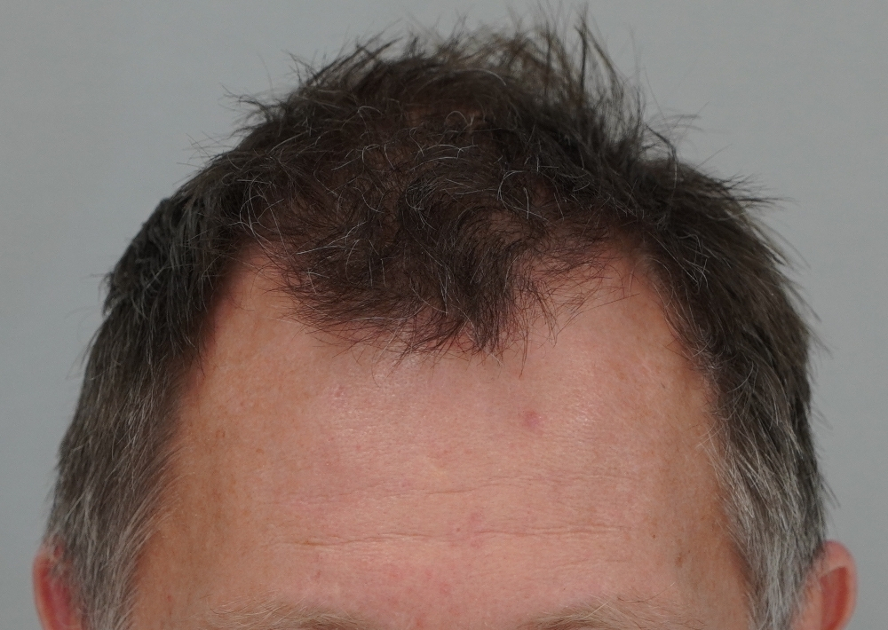 1987 grafts by FUE