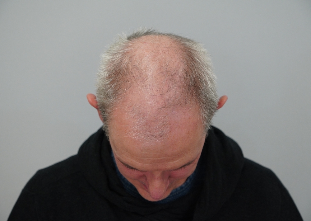 3354 grafts by FUE