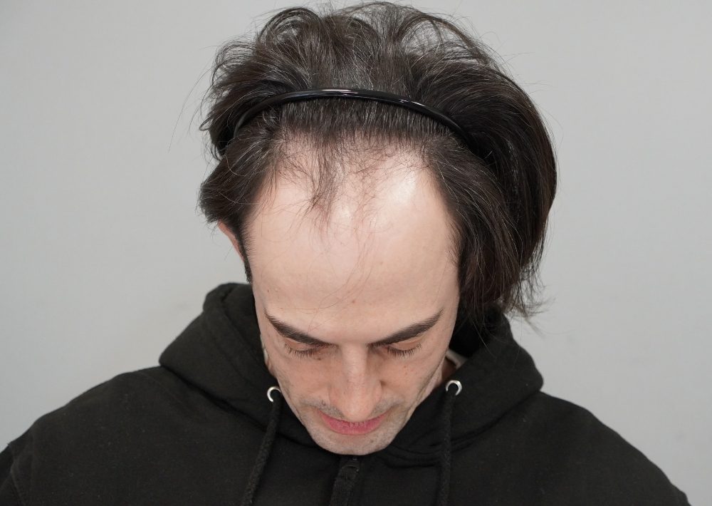 2027 grafts by FUE