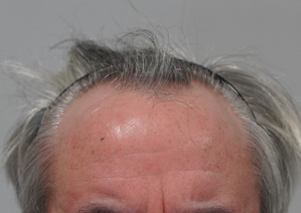 2210 grafts by FUE