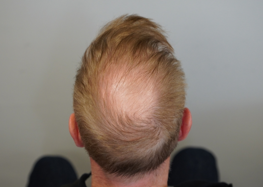 1547 grafts by FUE
