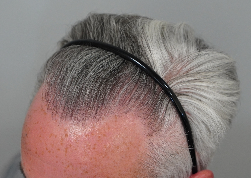2210 grafts by FUE