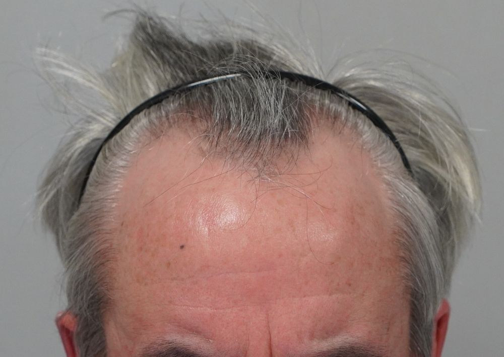 2210 grafts by FUE