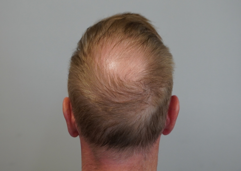 1547 grafts by FUE