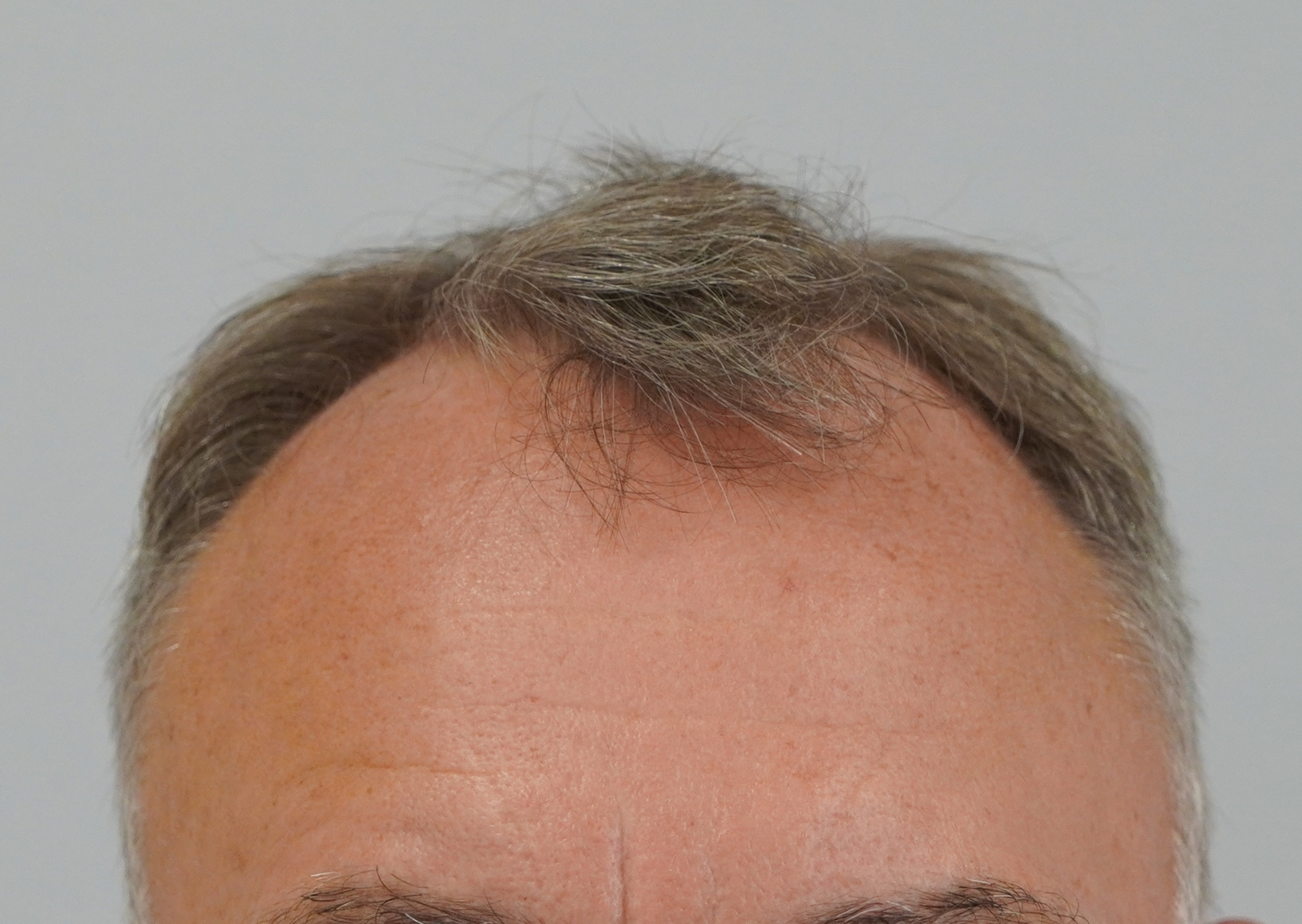 2506 grafts by FUE