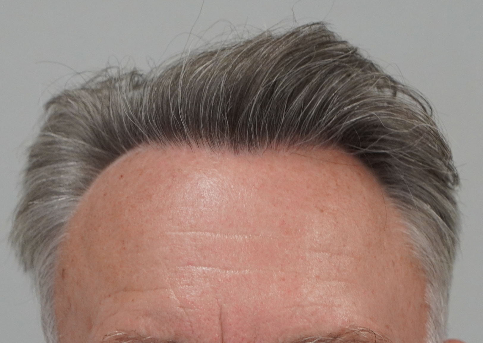 2506 grafts by FUE