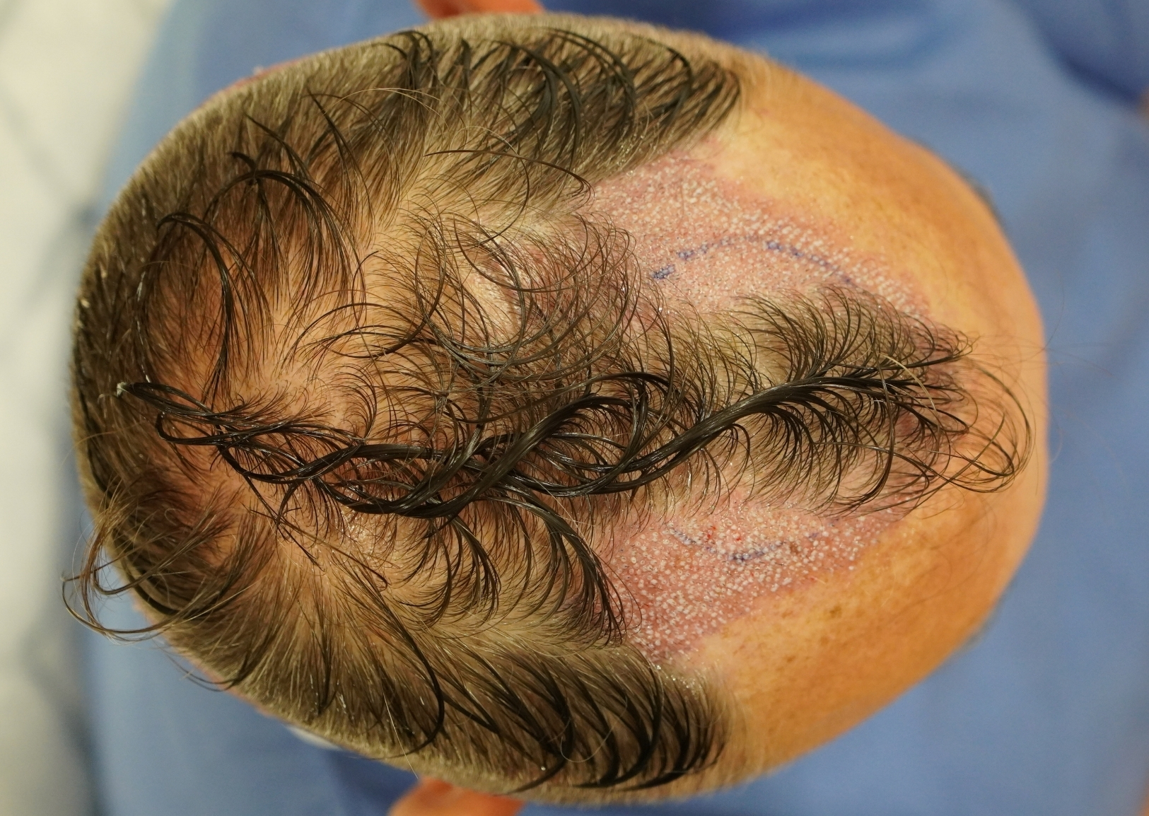 2506 grafts by FUE