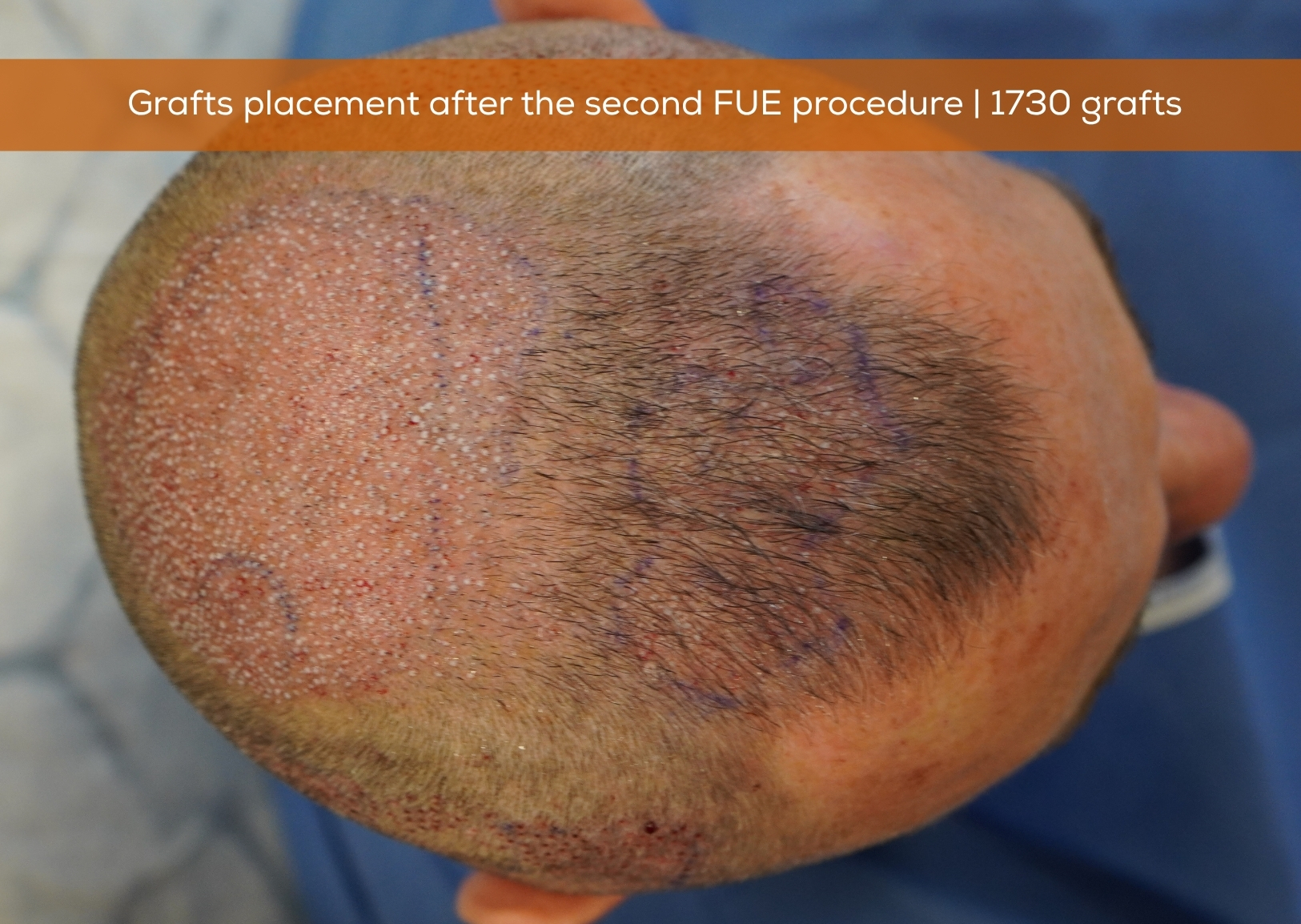 4171 grafts by FUE