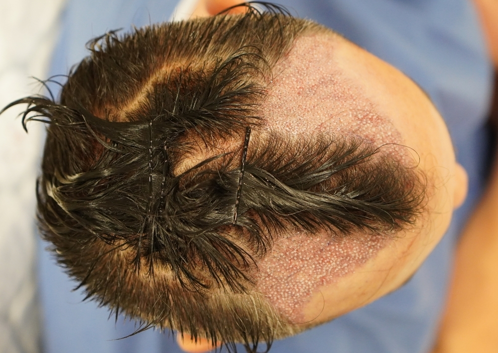1473 grafts by FUE